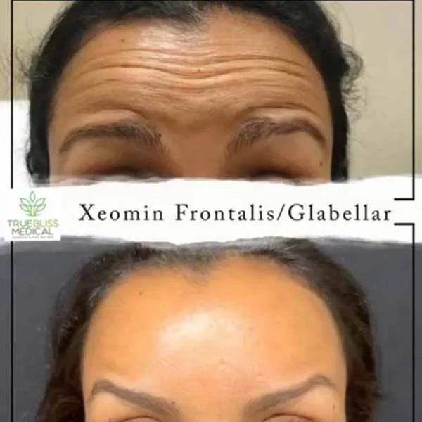 Botox neuromodulator patient result one