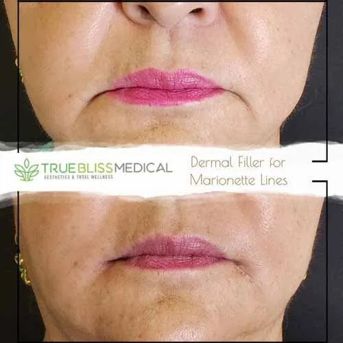 Dermal filler patient result one