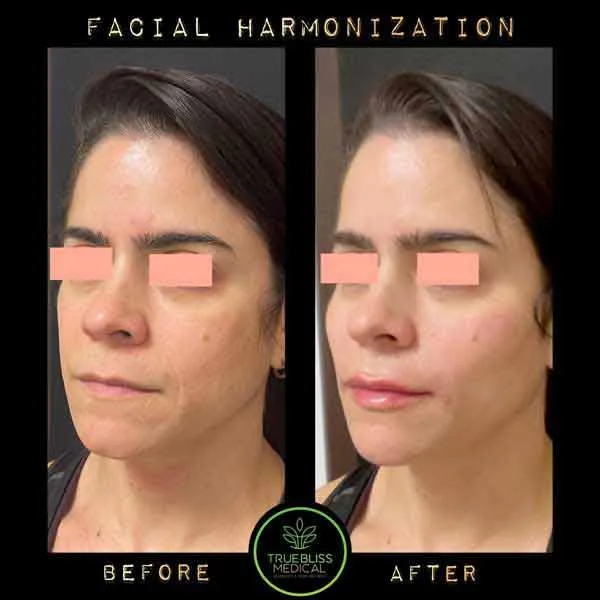 Facial rejuvenation patient result one