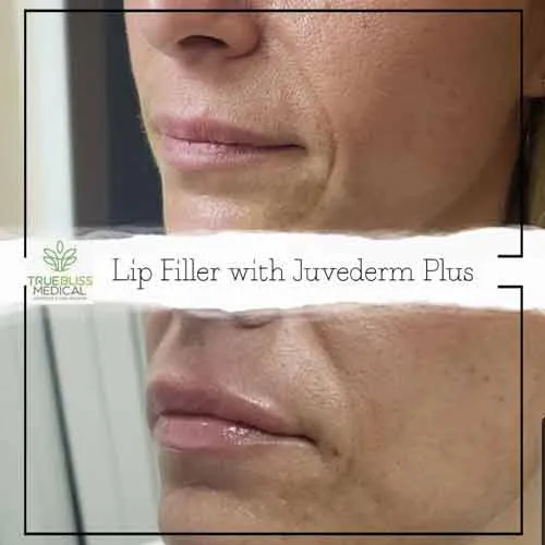 Dermal filler patient result two