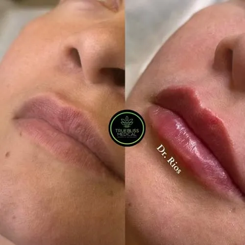 Lip filler patient result one