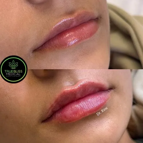 Lip filler patient result two