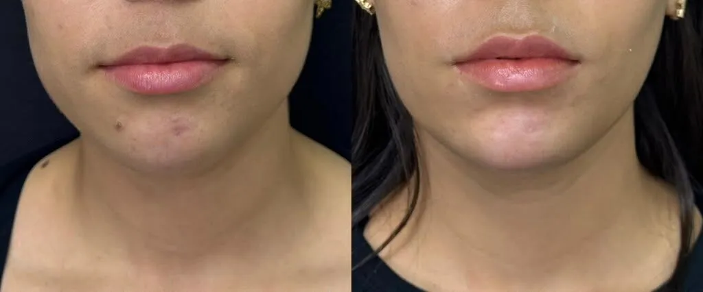 Botox for masseter muscle before and after result