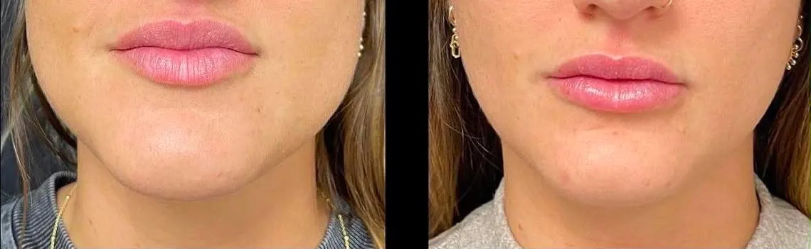 Botox for masseter muscle before and after result two