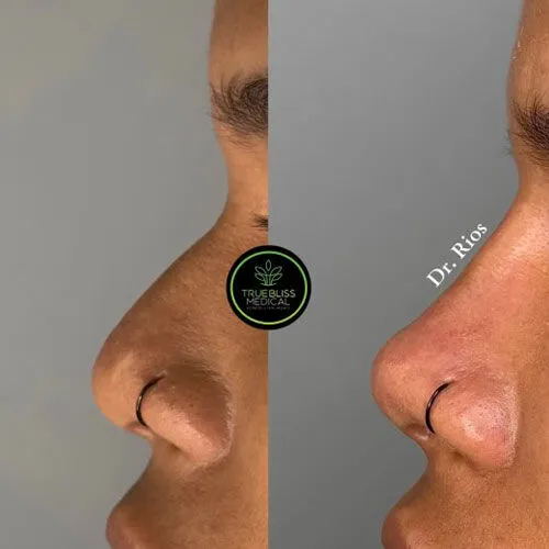 Non-surgical rhinoplasty patient result one