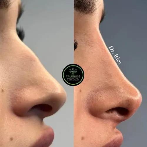 Non-surgical rhinoplasty patient result two