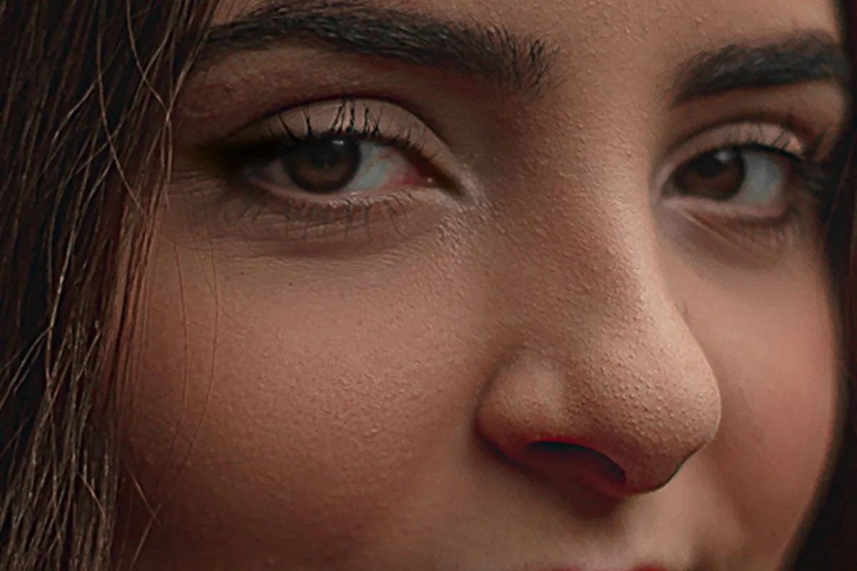 Can Fillers Fix a Crooked Nose?