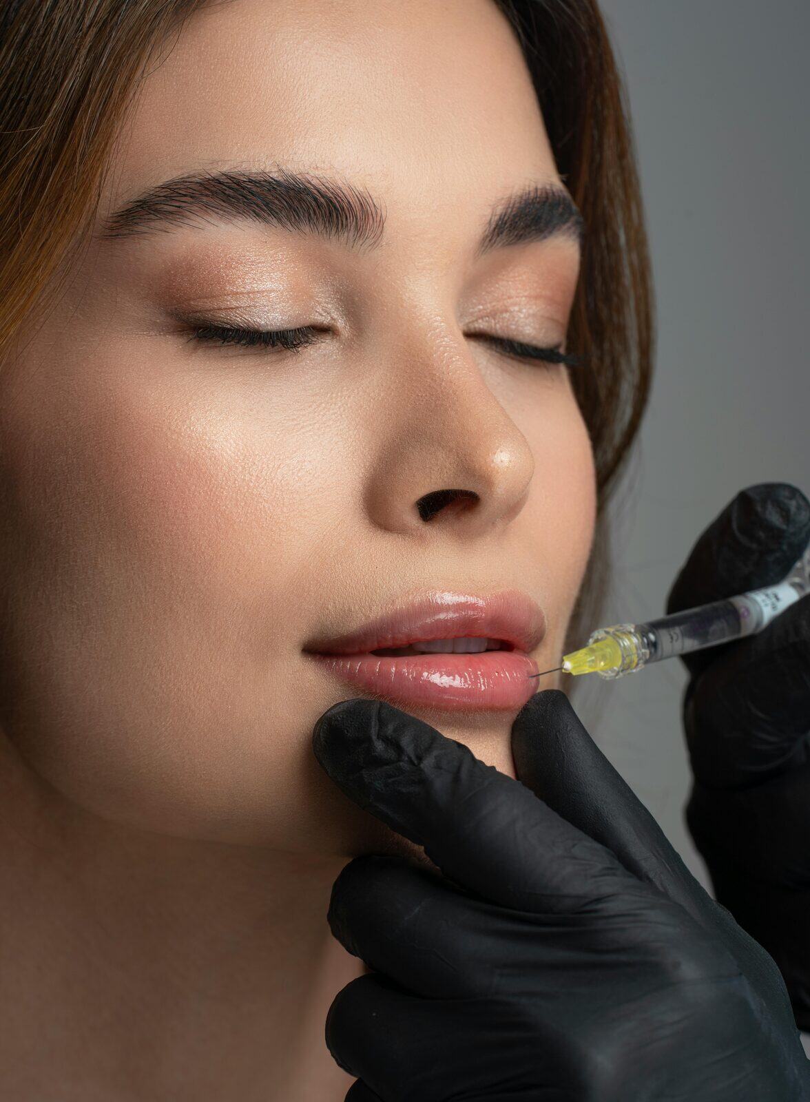 Lip filler treatment at True Bliss Medical
