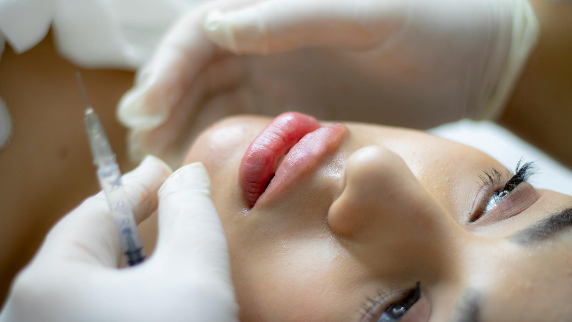 Lip Fillers for Natural Results Explained