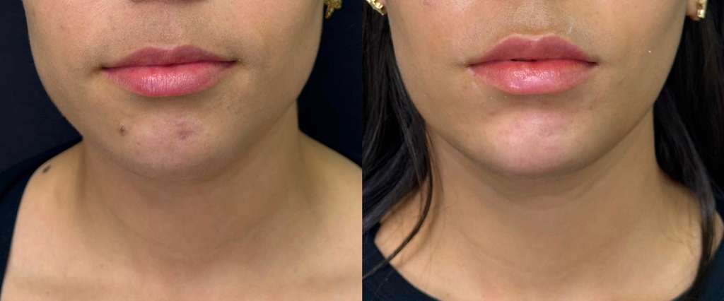 Masseter Botox jawline comparison at True Bliss Medical