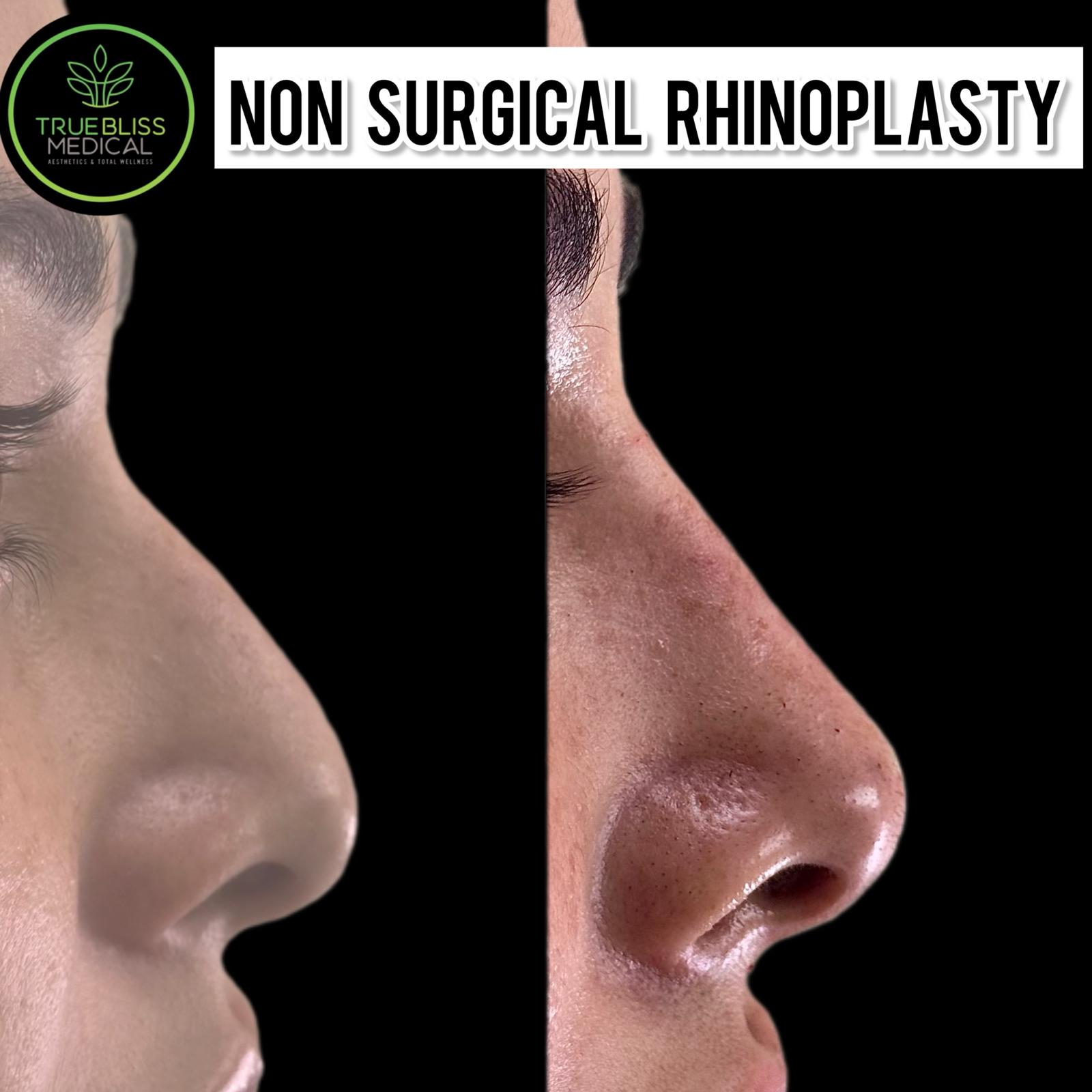 Non-surgical rhinoplasty before and after results at True Bliss Medical