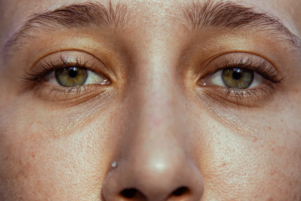 How PRF Improves Under-Eye Hollows