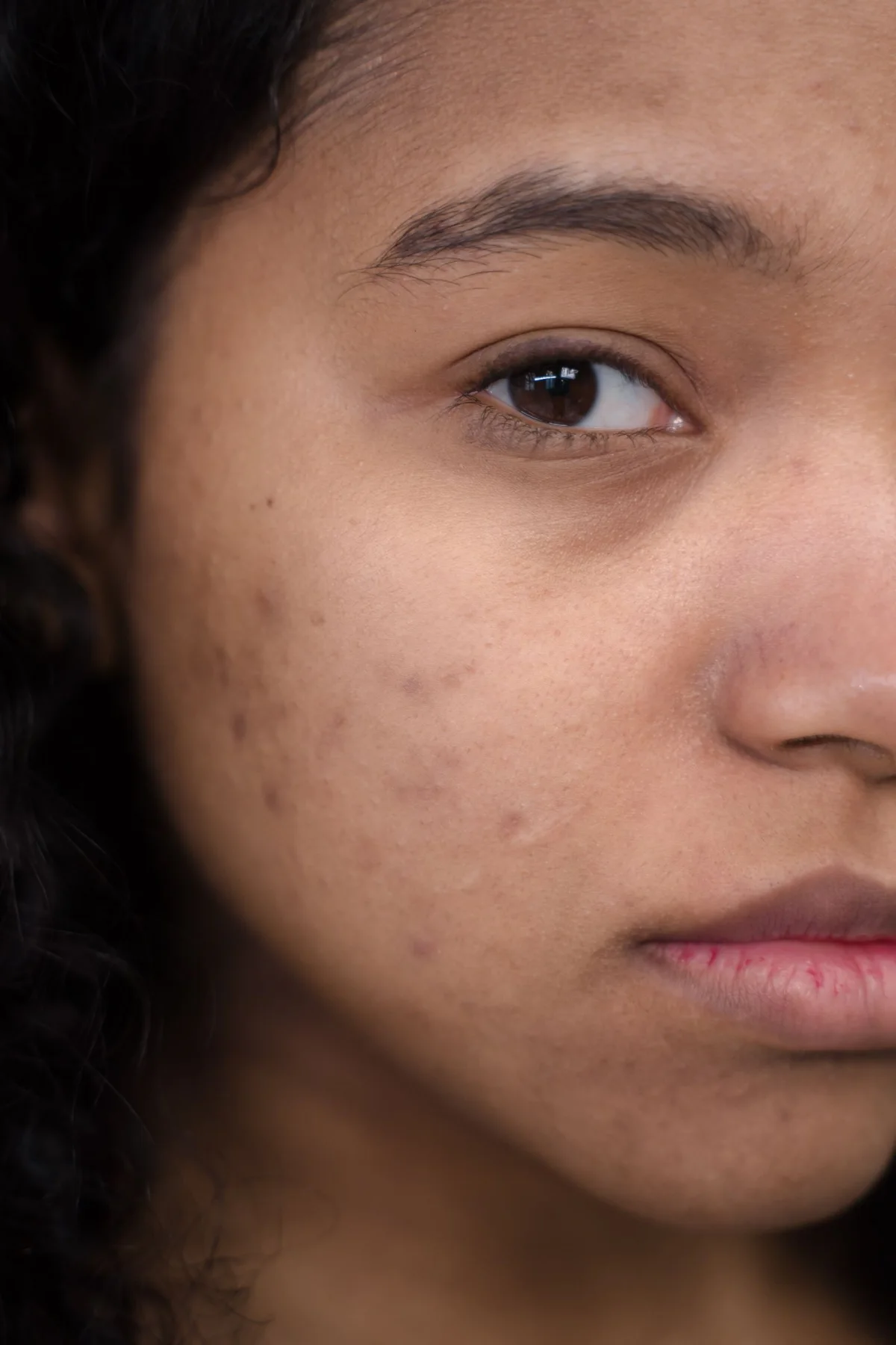 PRP Microneedling for Acne Scars