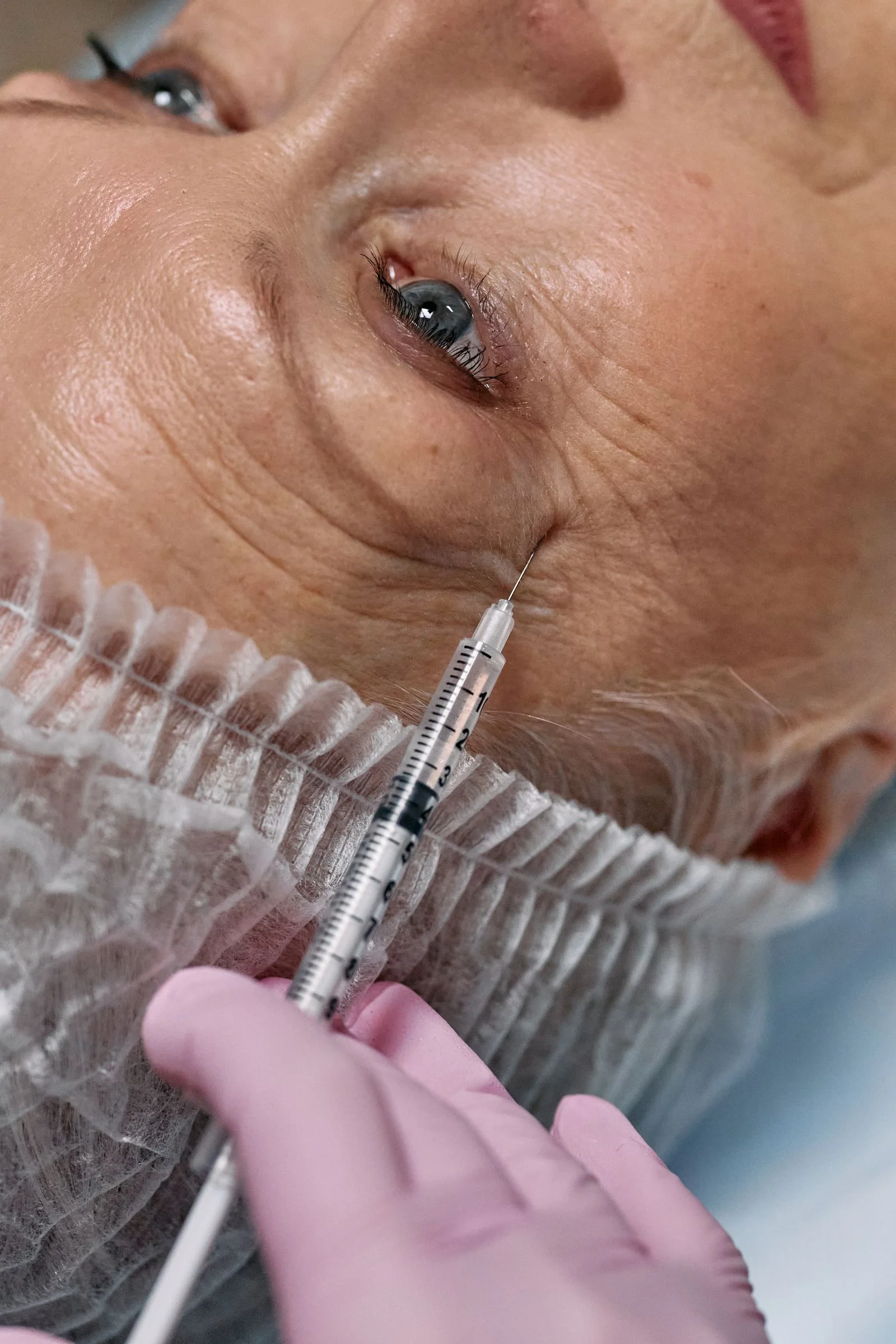 PRP Microneedling for Fine Lines and Wrinkles