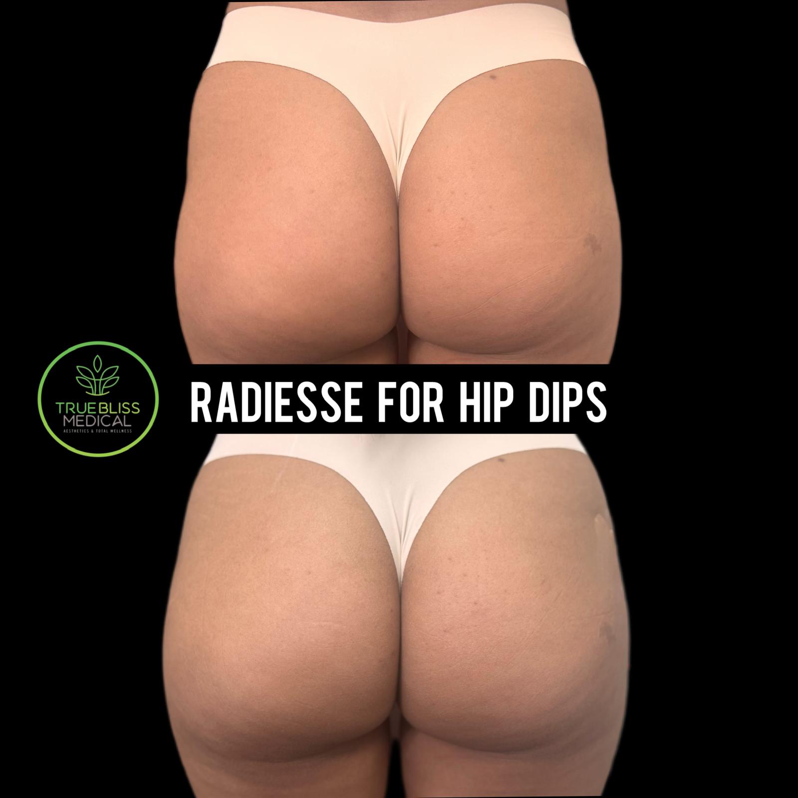 Hip dip treatment at True Bliss Medical