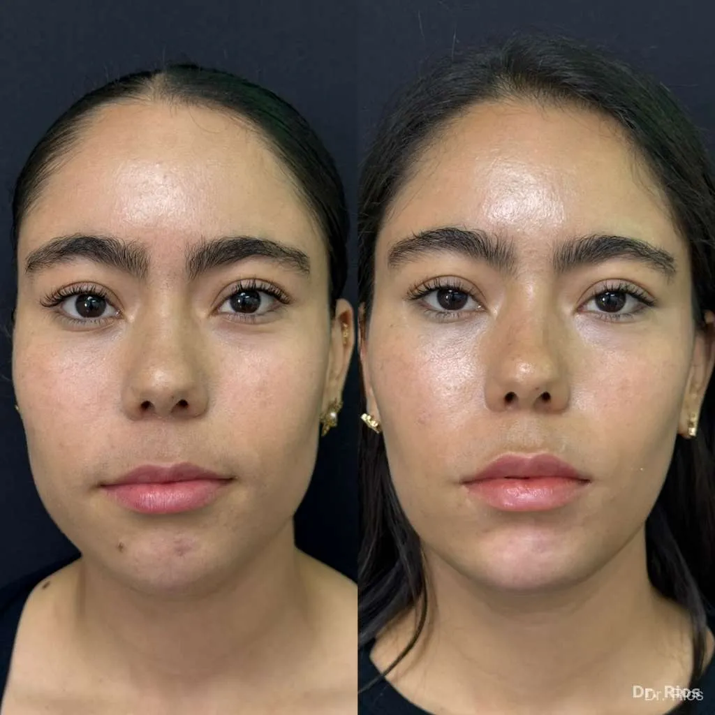 Facial rejuvenation before and after result