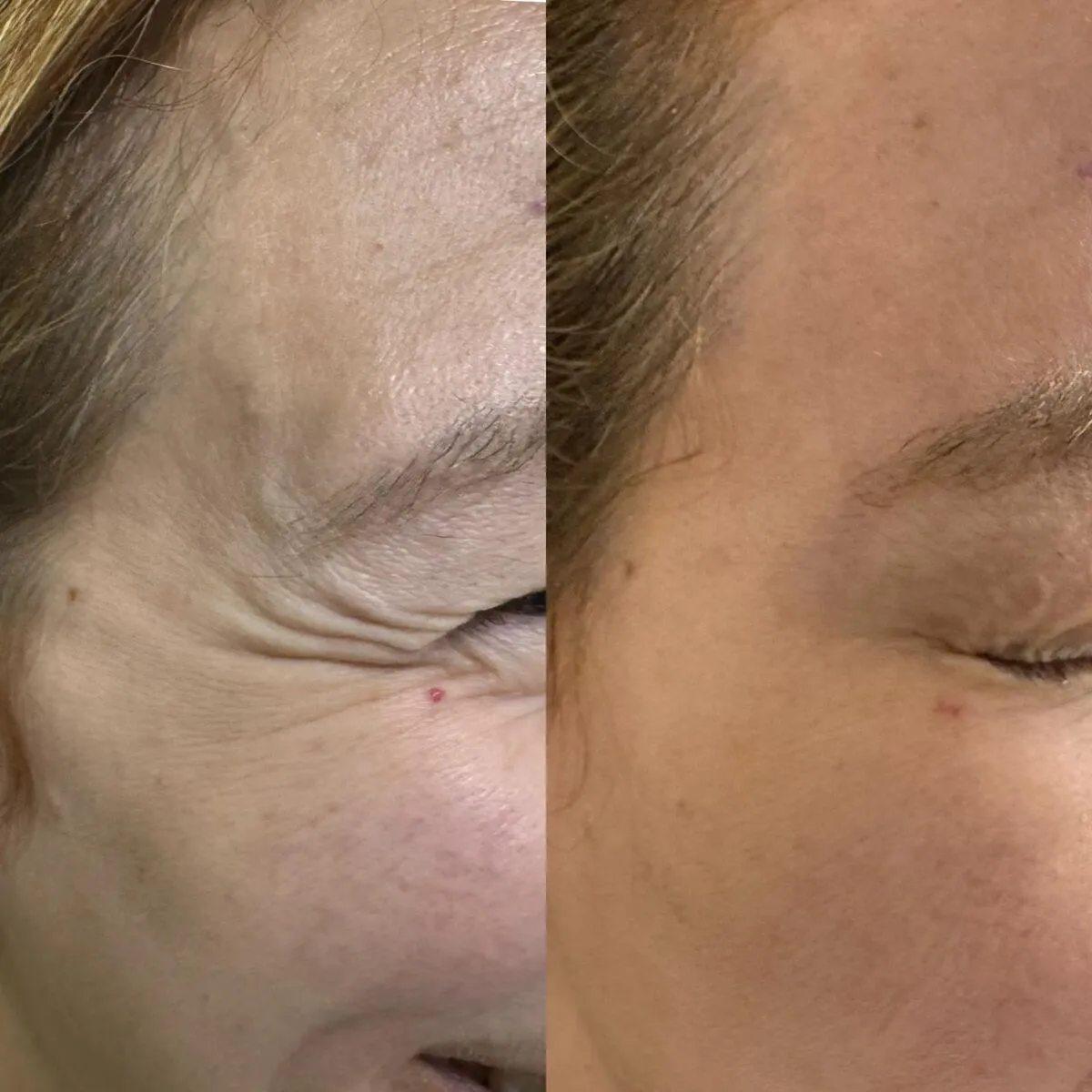 Botox for crow's feet before and after