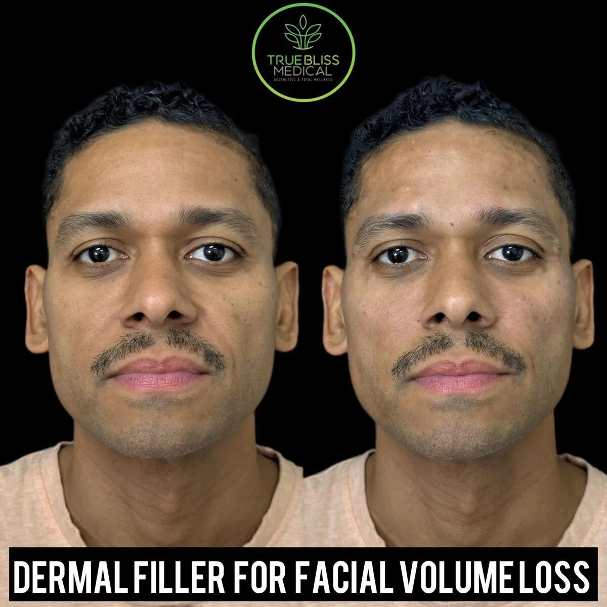 Dermal filler for facial volume loss before and after