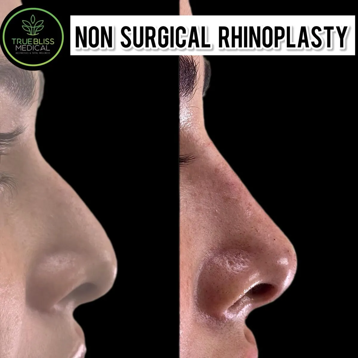 Non-surgical rhinoplasty before and after