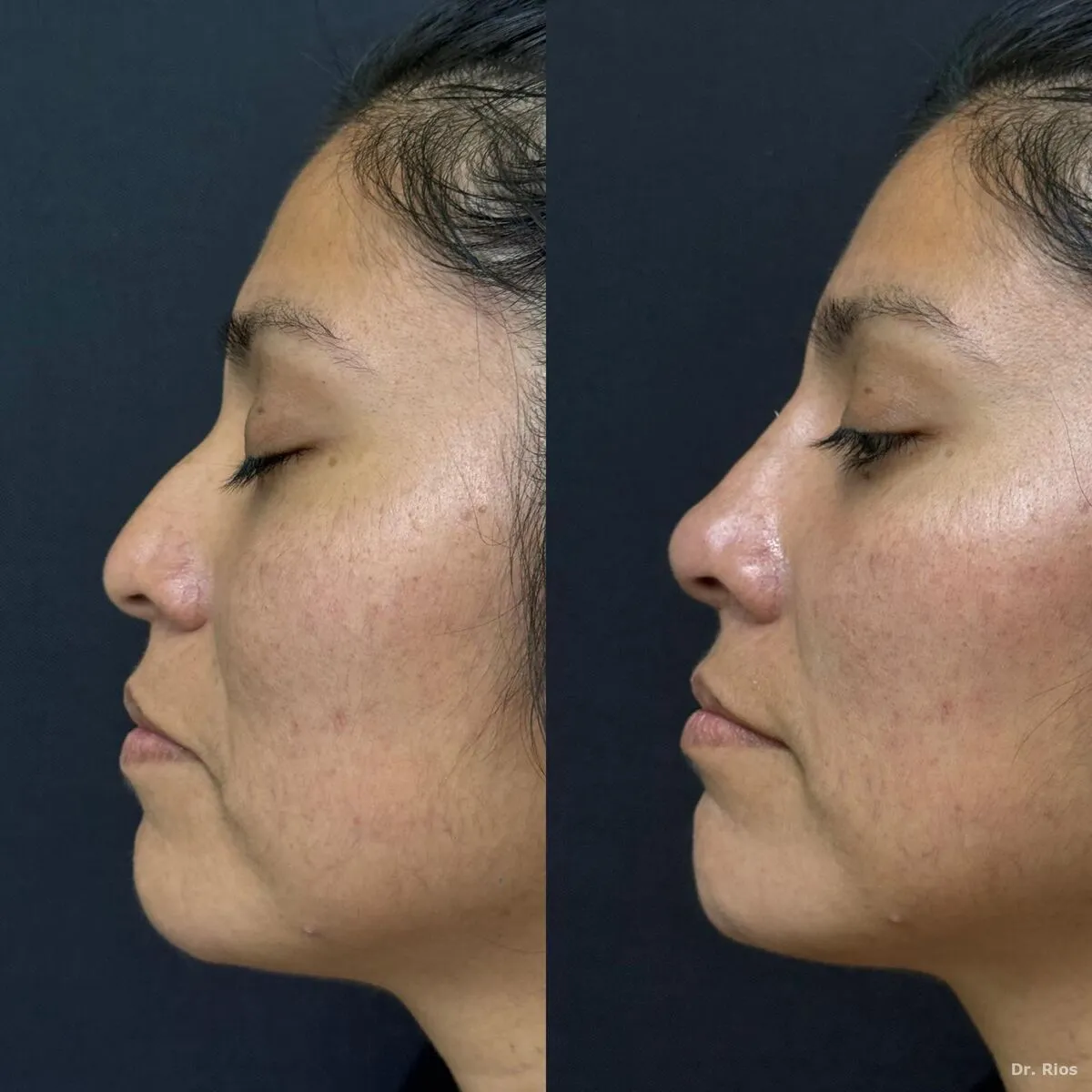 Nose and chin balancing before and after