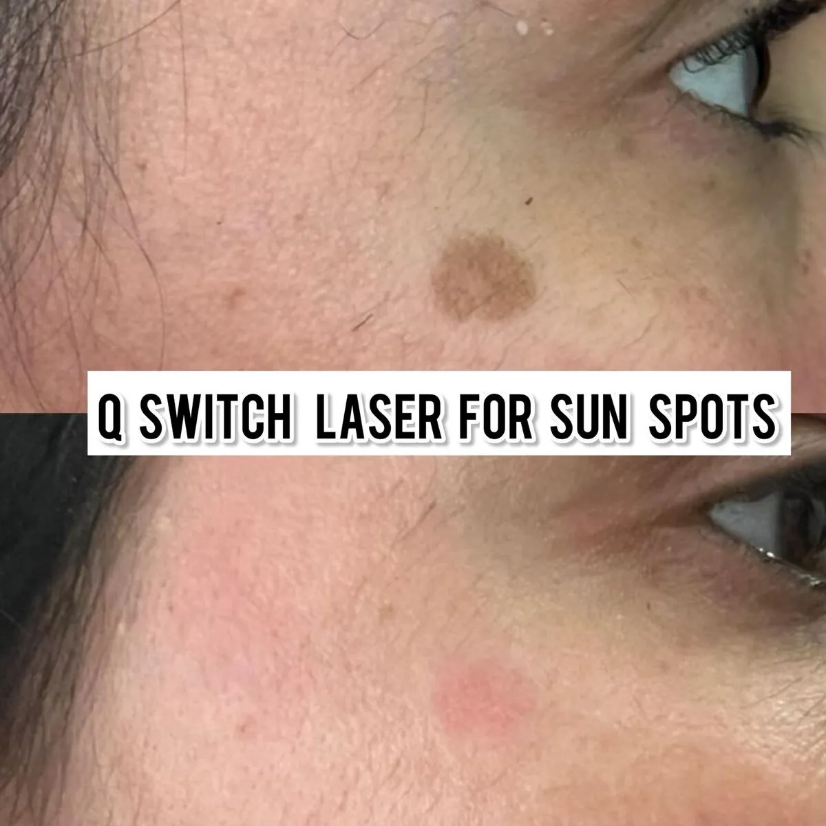 Q-Switch laser for sun spots before and after