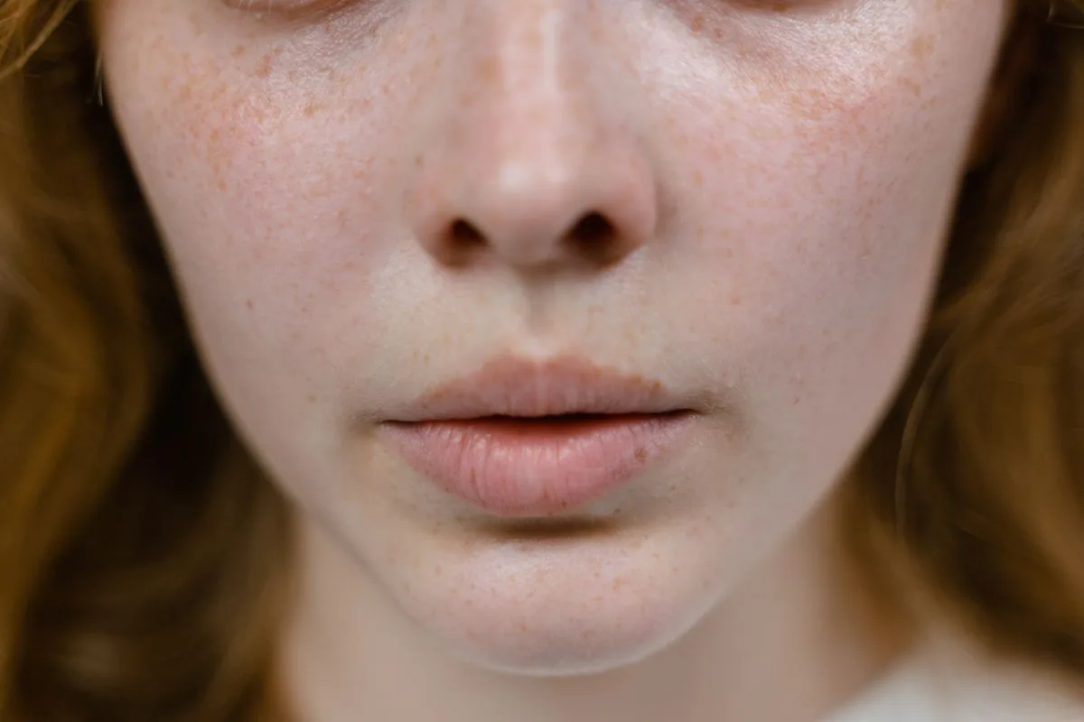 Who Is a Candidate for Non-Surgical Rhinoplasty?
