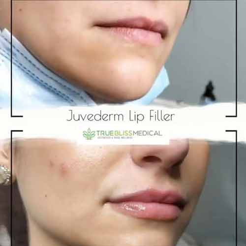 Lip Treatments Before & After in Verona, NJ