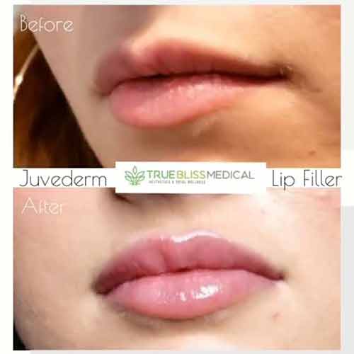 Lip Treatments Before & After in Verona, NJ