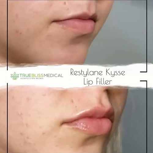 Lip Treatments Before & After in Verona, NJ