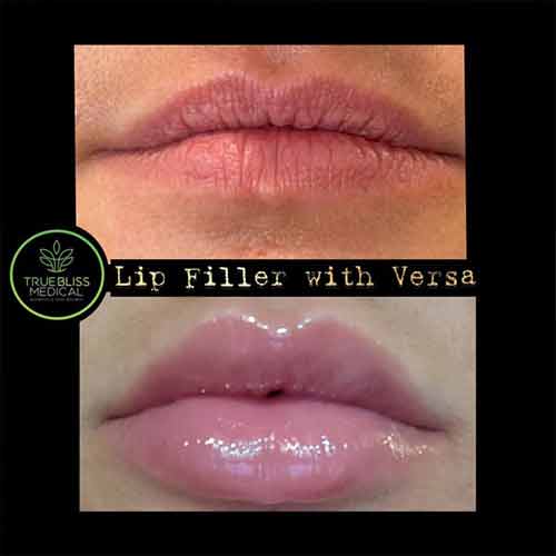 Lip Treatments Before & After in Verona, NJ