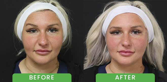 PDO Threads Lift Treatment Before & After in Verona, NJ PDO Threads Lift Treatment Before & After in Verona, NJ