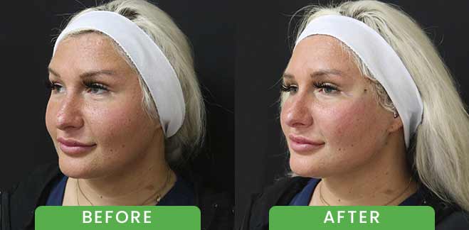 PDO Threads Lift Treatment Before & After in Verona, NJ PDO Threads Lift Treatment Before & After in Verona, NJ