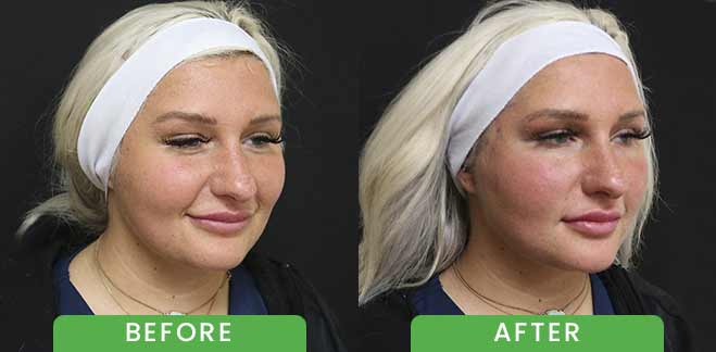 PDO Threads Lift Treatment Before & After in Verona, NJ PDO Threads Lift Treatment Before & After in Verona, NJ