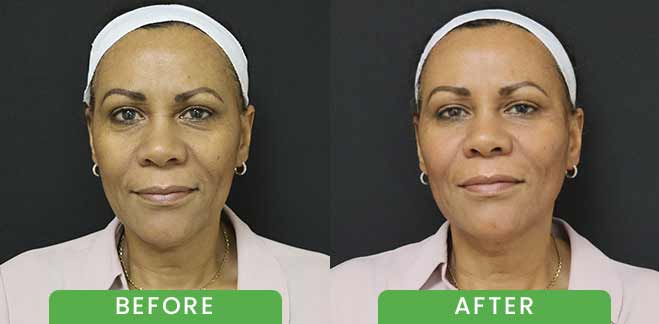 PDO Threads Lift Treatment Before & After in Verona, NJ PDO Threads Lift Treatment Before & After in Verona, NJ