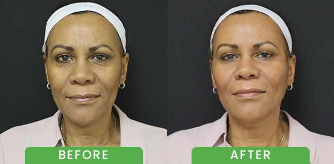 PDO Threads Lift Treatment Before & After in Verona, NJ