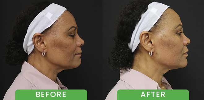 PDO Threads Lift Treatment Before & After in Verona, NJ PDO Threads Lift Treatment Before & After in Verona, NJ