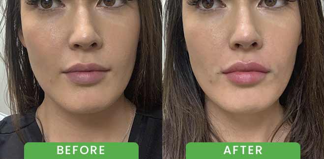 Dermal Fillers Before & After in Verona, NJ