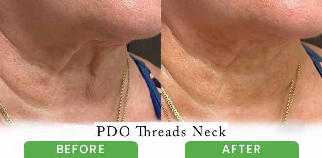 PDO Threads Lift Treatment Before & After in Verona, NJ PDO Threads Lift Treatment Before & After in Verona, NJ