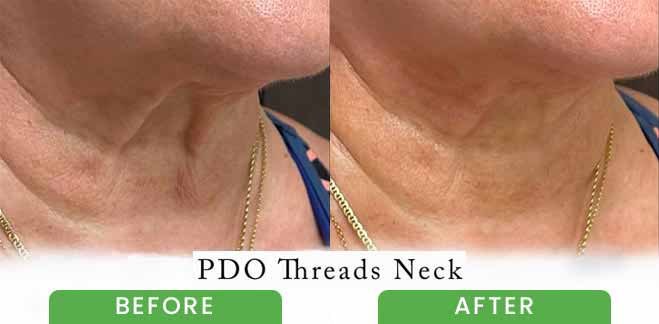 PDO Threads Lift Treatment Before & After in Verona, NJ