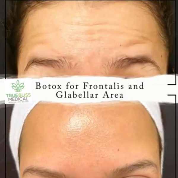 PDO Botox/Neuromodulator Treatment Before & After in Verona, NJ 