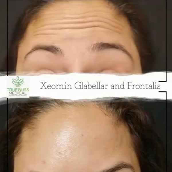 PDO Botox/Neuromodulator Treatment Before & After in Verona, NJ 