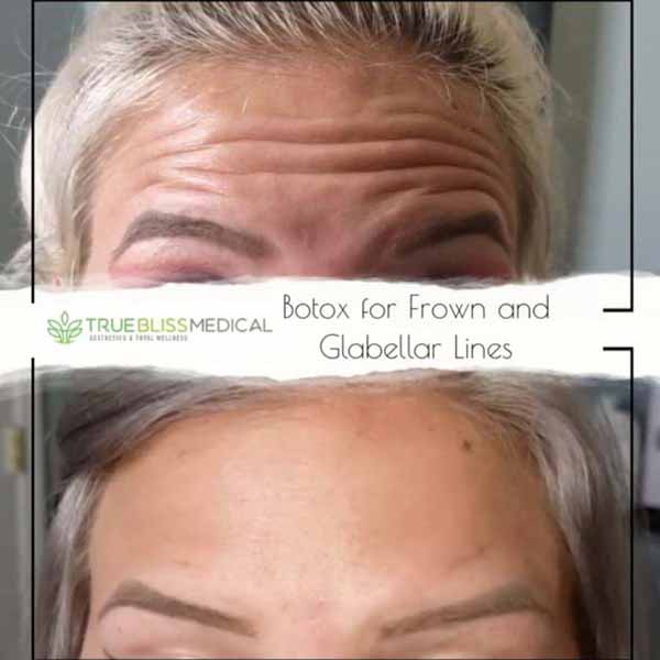 PDO Botox/Neuromodulator Treatment Before & After in Verona, NJ 