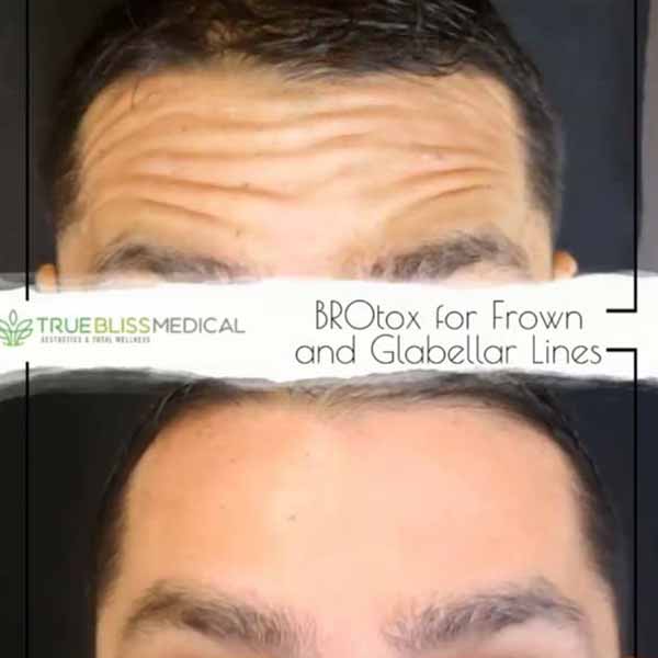 PDO Botox/Neuromodulator Treatment Before & After in Verona, NJ 