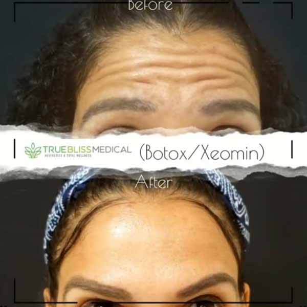 PDO Botox/Neuromodulator Treatment Before & After in Verona, NJ 