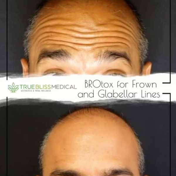 PDO Botox/Neuromodulator Treatment Before & After in Verona, NJ 