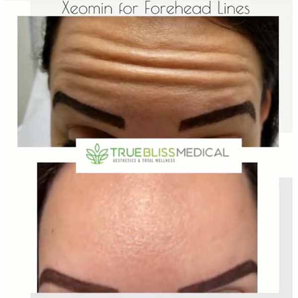 PDO Botox/Neuromodulator Treatment Before & After in Verona, NJ 