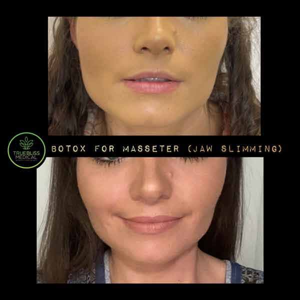 PDO Botox/Neuromodulator Treatment Before & After in Verona, NJ 