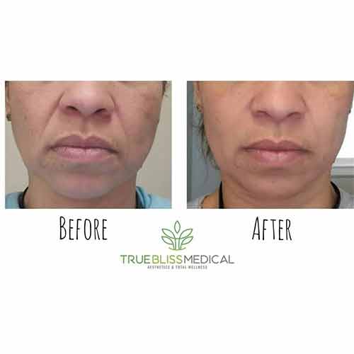 Nasolabial Folds & Marionette Lines Treatment Before & After in Verona, NJ