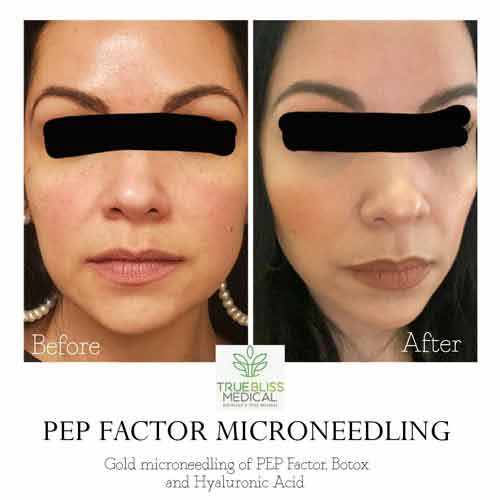 Skin Rejuvenation Before & After in Verona, NJ