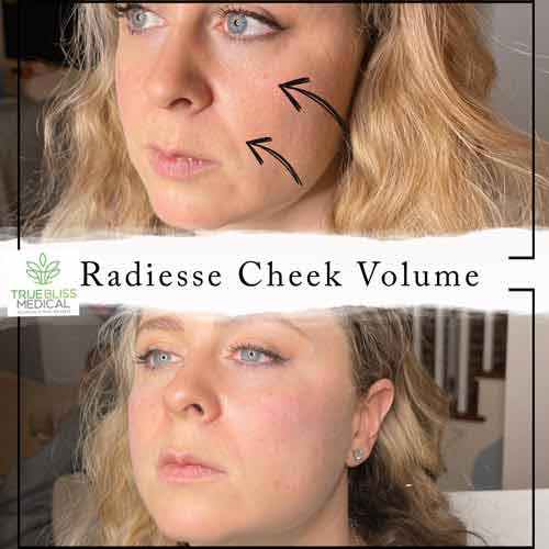 Cheek Fillers Before & After in Verona, NJ